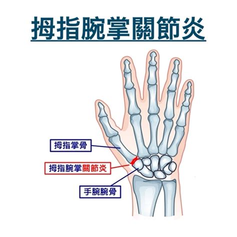 第一掌指關節|手部關節炎 